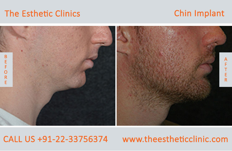 chin Augmentation, chin Implants surgery before after photos in mumbai india (4)